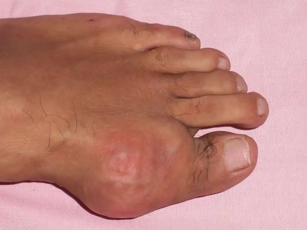 痛风在疾病中发病率呈逐年上升趋势,浅谈痛风的症状以及根源