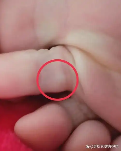 脚趾上长了个硬鼓包