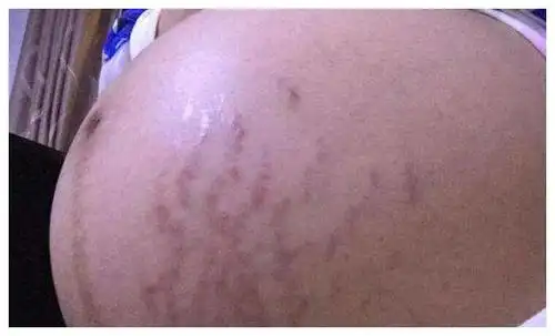 怀孕期间肚子里是男孩还是女孩4种症状帮你判断建议收藏