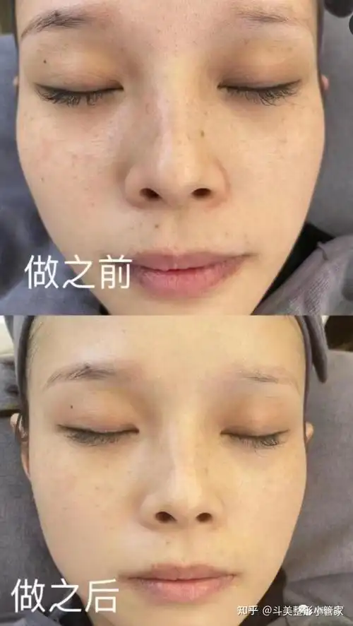 20打水光针,细腻又光滑;下面对比图让你知道水光针真的不是盖的!