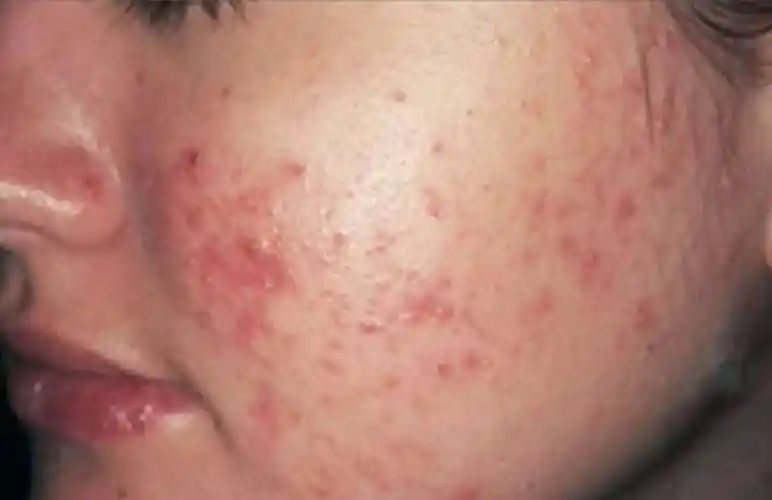 丘疹脓疱型玫瑰痤疮的治疗