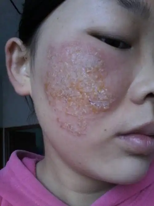 刚开始发红,发烧,之后结痂,流脓溃烂.一直持续到现在,我