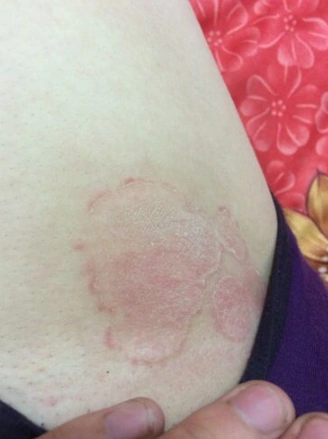 体股癣初期现象图片 (35)_有来医生