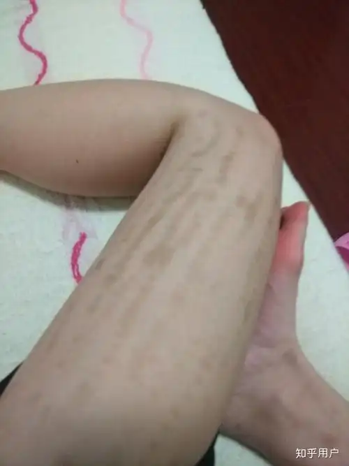 激光脱毛黑色素沉淀怎么办?