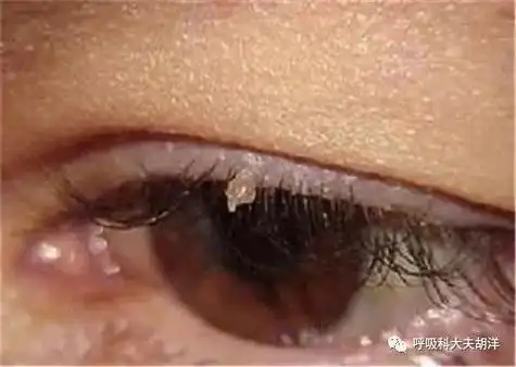 免疫力低下的表现,女子感染hpv,脖颈上长出小肉疙瘩!_腾讯新闻