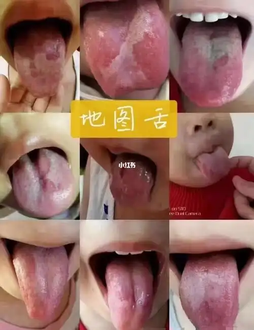 艾艾贴与您分享95 地图舌的原因,一般分为: 941.