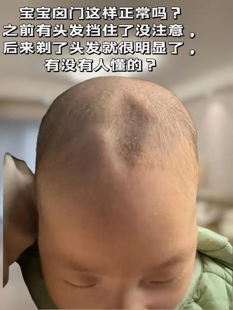 姐妹们宝宝这样囟门这样正常吗?月子里有头发挡住看不出来