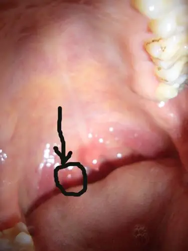 咽喉部小疙瘩是炎症还是肿瘤