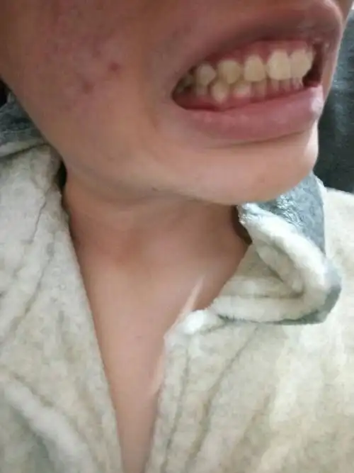 我的上颌骨突出,牙齿咬合前面中间牙齿突出很多,17岁,怎么办,费用