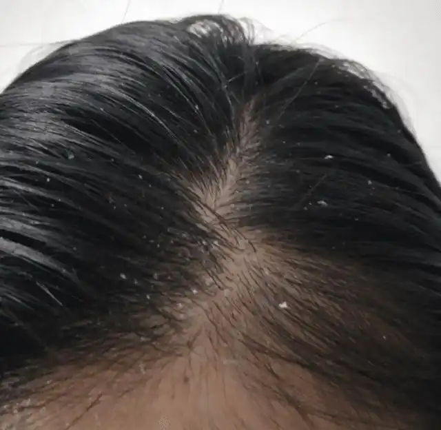 头皮屑掉得多,还特别痒,小心是这种情况,不趁早治会很严重!_损伤
