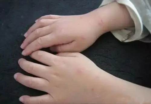 宝宝5个月大手足口病图片_有来医生