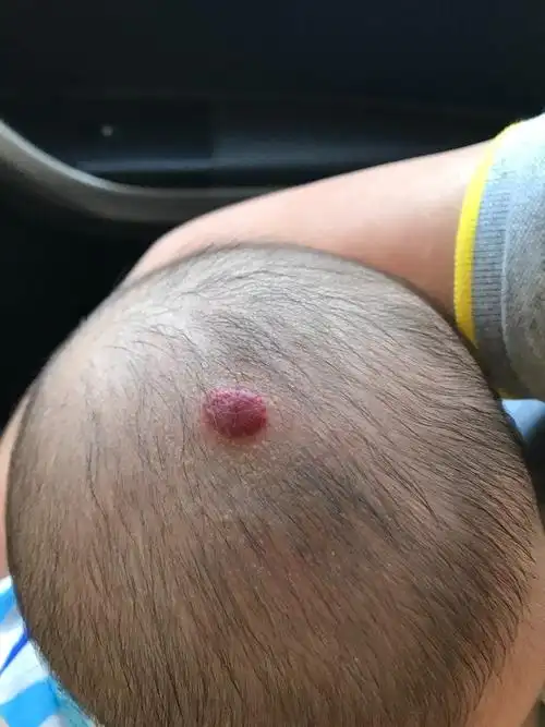 第一张照片所示,42天体检医生说是血管瘤,仍未凸起;4月30日给宝宝理发