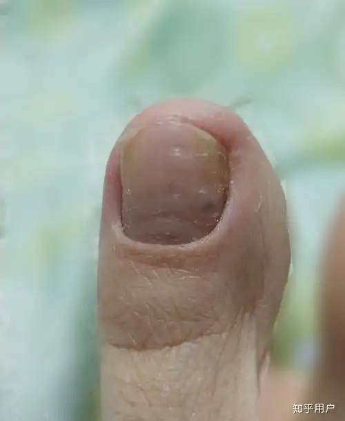 脚趾甲里出现一黑点是怎么回事?
