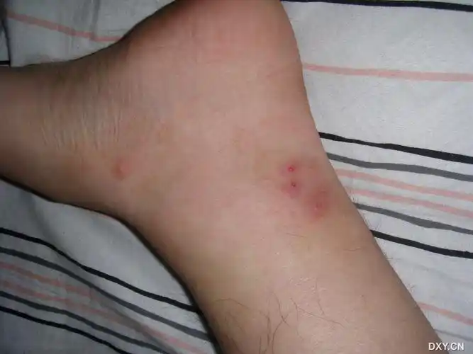 患者男,28岁,2天前无明显诱因下好现在左内踝后侧有5个水泡状皮疹如图