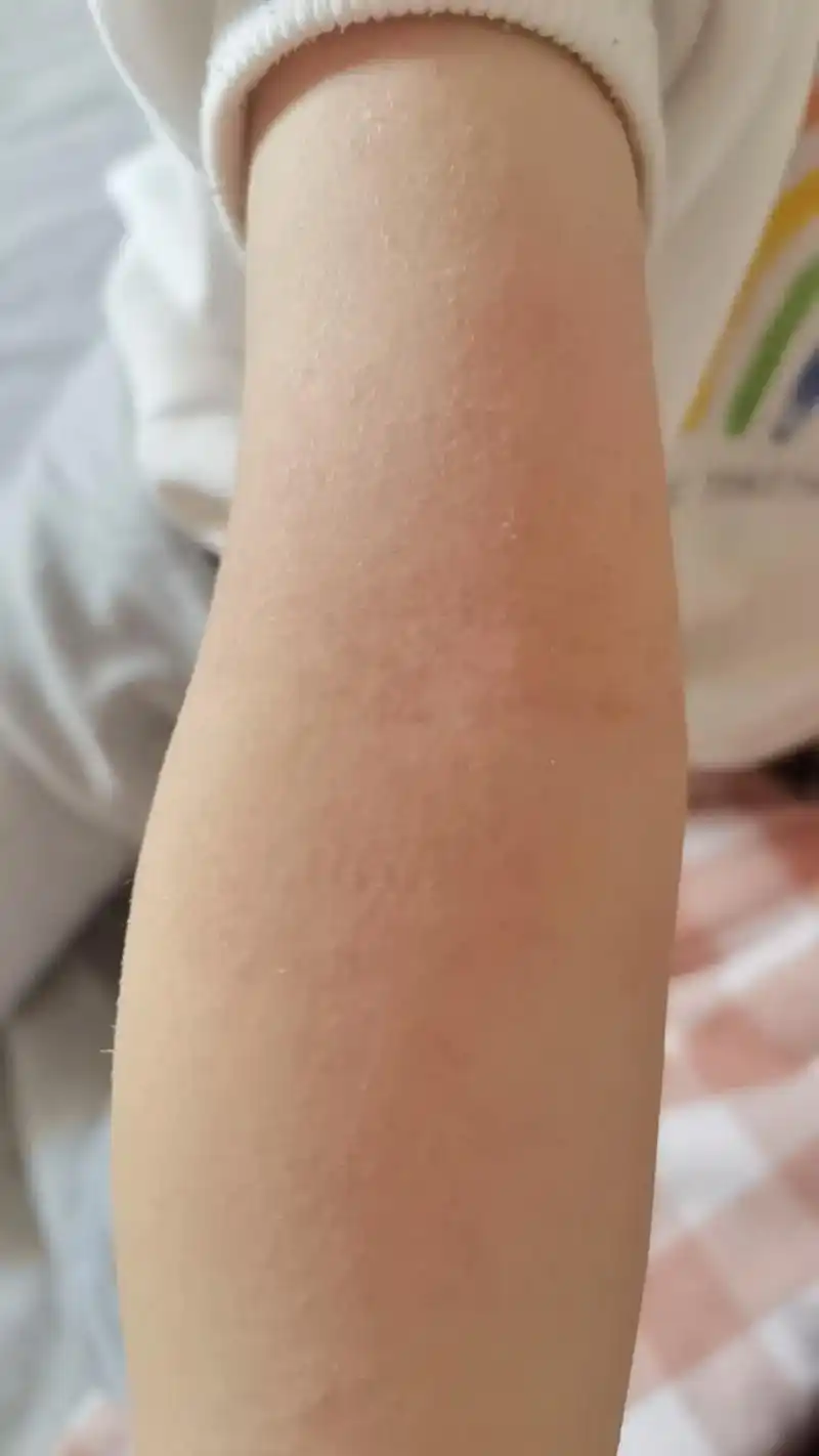 过敏性湿疹宝宝.#过敏性湿疹 #好敏感的皮肤 #只有宝妈才懂 - 抖音