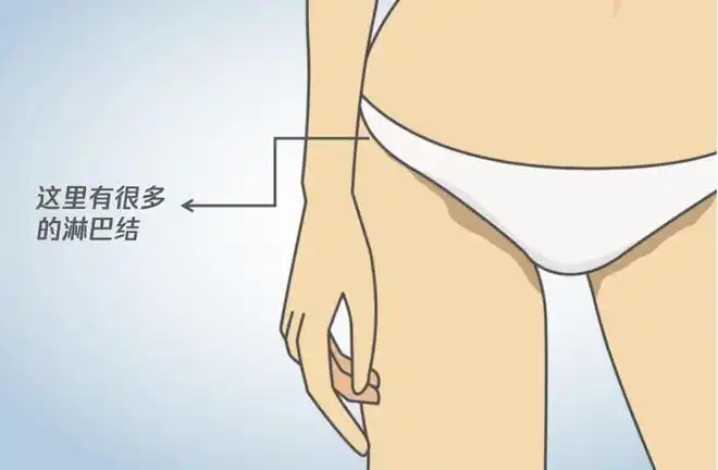 私处长了"小疙瘩",可能不是妇科病而是淋巴结肿大