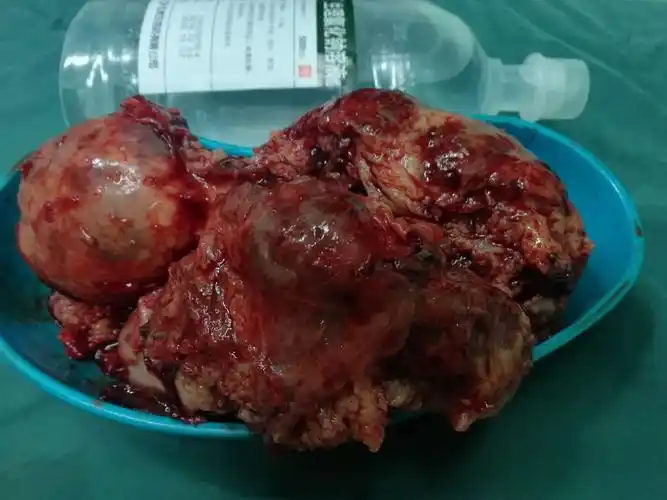 肋骨,胸内巨大肿瘤