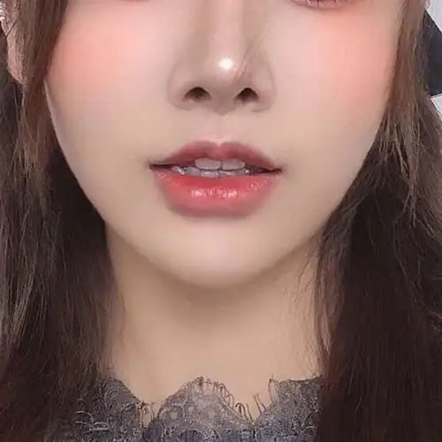 人中缩短唇部综合的二个月人中缩短