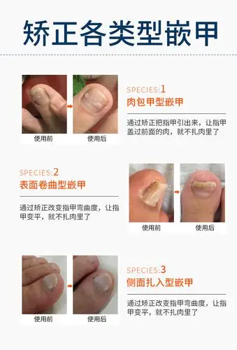 甲沟嵌甲纠正神器炎拉拉脚趾甲贴片指甲长肉里勾修脚刀正甲贴套装