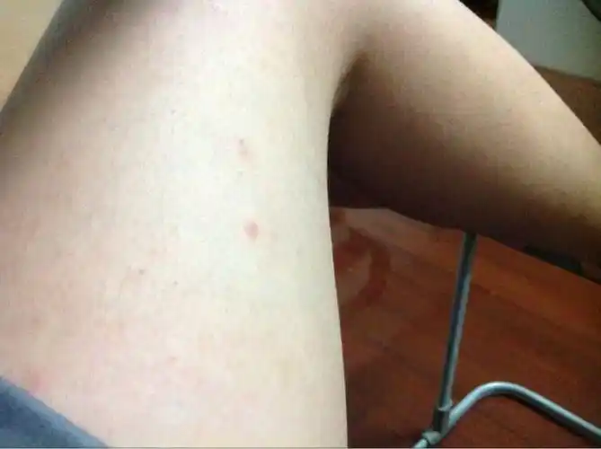 皮肤上出现小红点