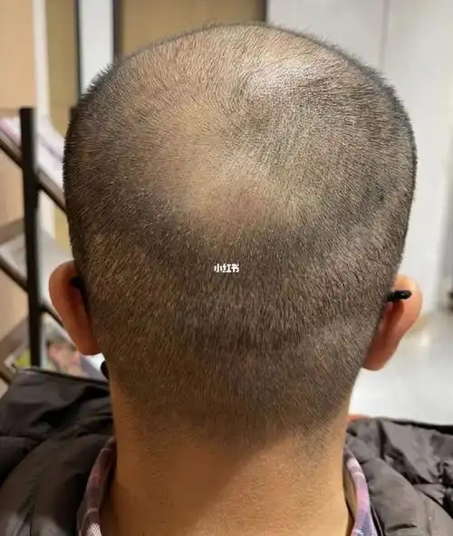 找到一种方式,让你头顶上的发量大增