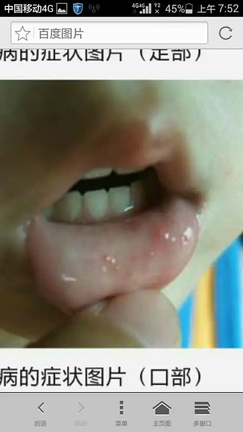 手足口的口腔疱疹