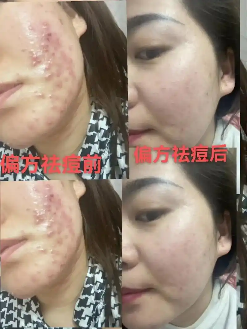 痘疤痘坑的成因