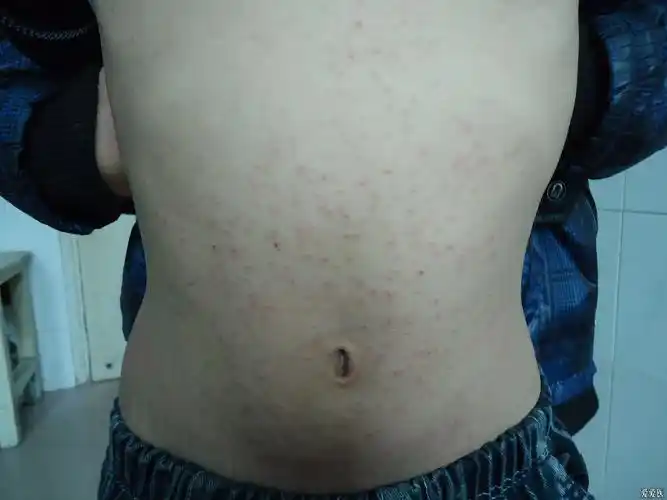 几张典型的疥疮图片