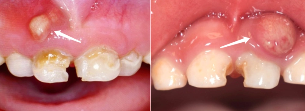 然而,肿包却反反复复,到齿科一检查竟被告知:要做根管治疗.