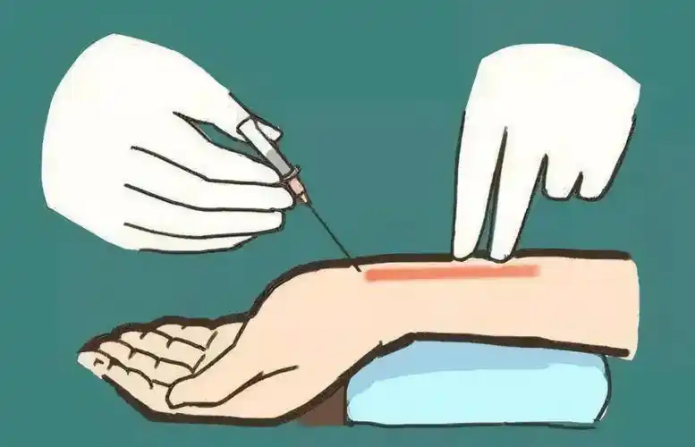 今天和大家一起来聊聊桡动脉采血_手掌_循环_allen