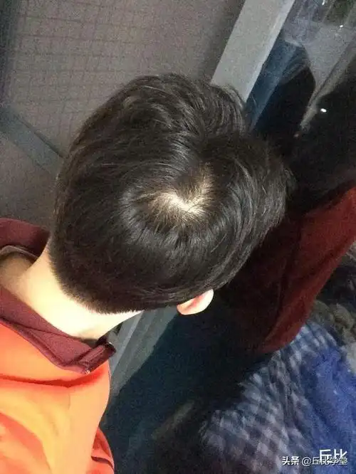 为什么同大取大同小取小人头上为什么会有发旋一个