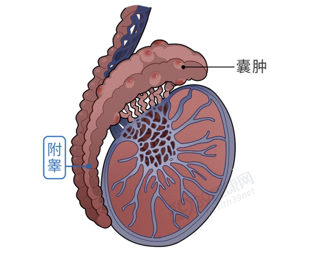什么是"附睾囊肿"?给男性带来什么危害?