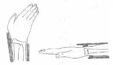 桡骨下端伸直型骨折固定法