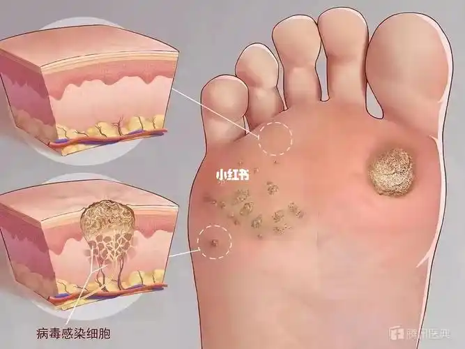 很多人不知道跖疣是啥