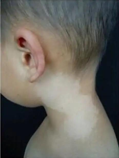 拥有白色胎记是怎样的命运_达一风水网