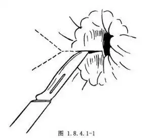 肛管yv皮瓣成形术