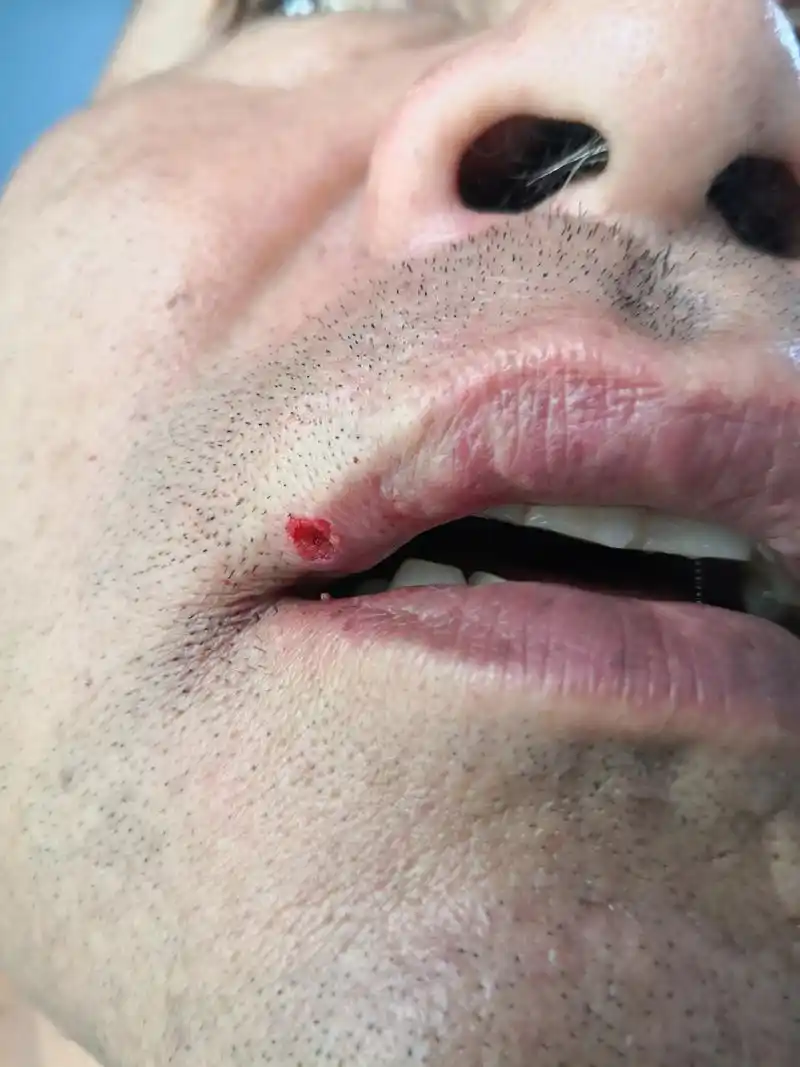 看似血管瘤,实际是肉芽肿,生长迅速,容易破溃出血,感染化脓.