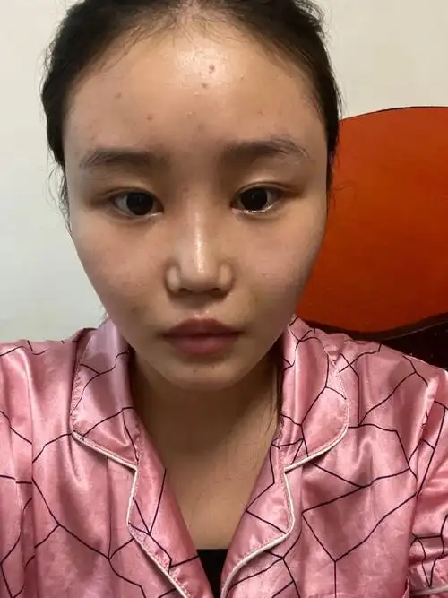 鼻子做完多了两条坑,有谁知道怎么回事吗