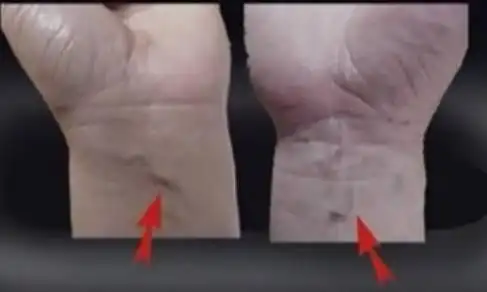 手上青筋暴起可能是这些疾病的征兆