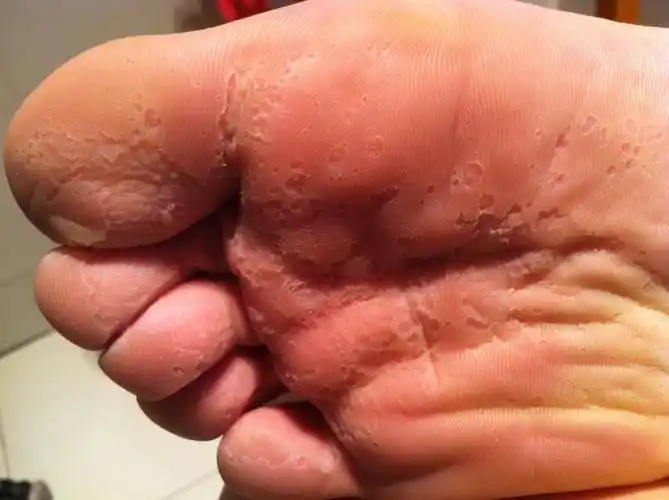 我的脚底板上有密密麻麻地小窟窿,不疼不痒,但是看起来很恐怖,附图如