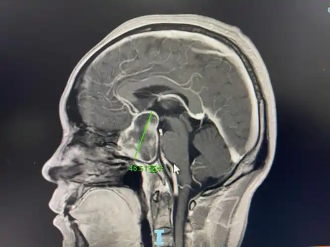 头痛视力下降警惕垂体瘤伴出血