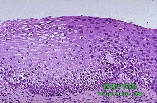左侧为正常子宫颈鳞状上皮,右侧为非典型增生的鳞状上皮,表现为细胞