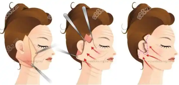 风筝小拉皮手术过程图示8682.cc