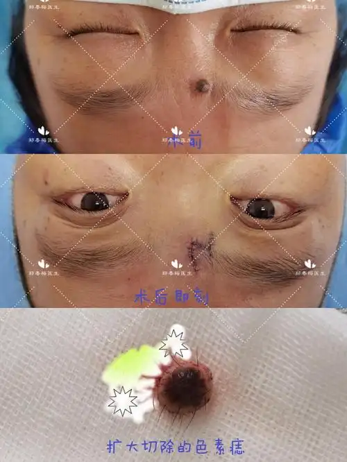 面部不同部位色素痣的切除与美容修复 - 好大夫在线