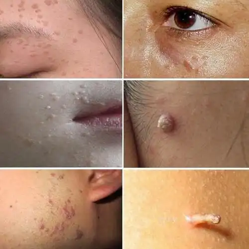 菜花状肛门尖锐湿疣图片