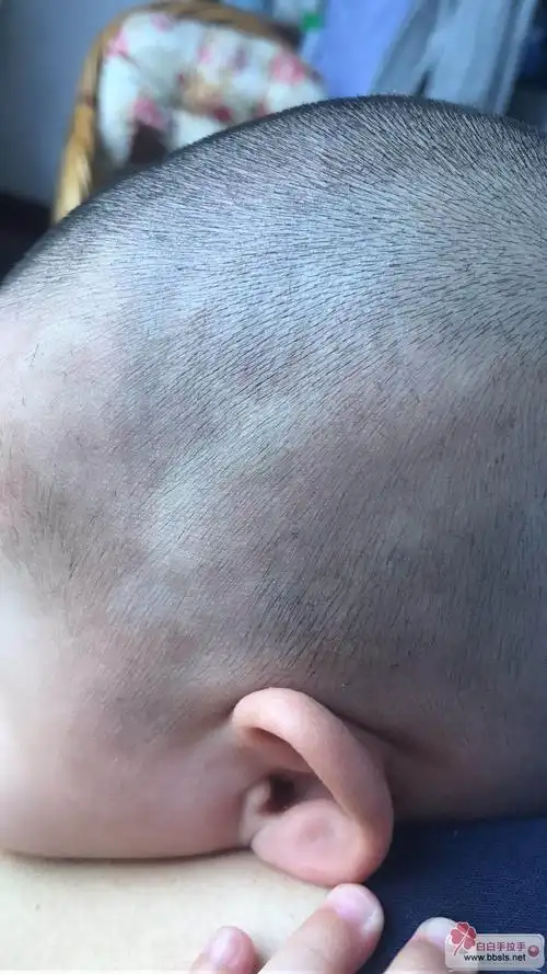 7个月(这周)发现白斑扩大了