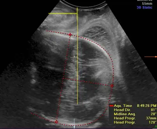 三维超声的产科疾病