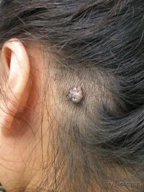 典型病例交流17皮内痣