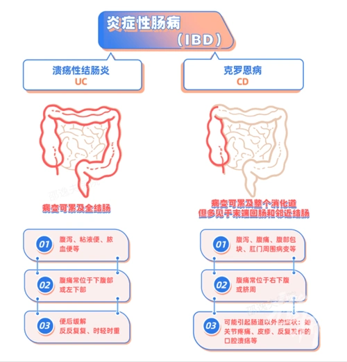 范一宏表示,炎症性肠病包括溃疡性结肠炎(ulcerativecolitis,uc)和