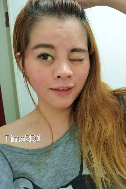 [保养]再见/再也不见--恼人酒糟肌byebye全纪录@京砚联合诊所